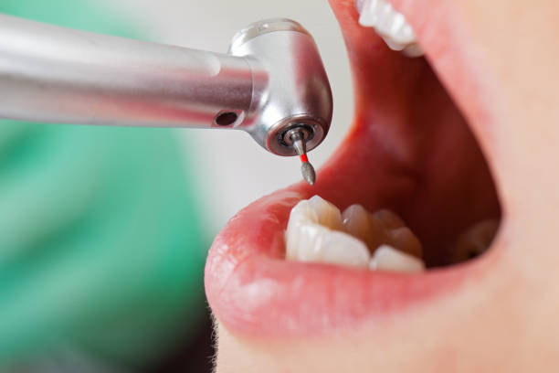Best Emergency Root Canal Therapy in Longbranch, WA